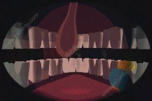 Tonsil Terror中文游戏（扁桃体惊魂）图片1
